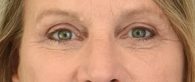 Brow Lift Patient 15 Set 1 After